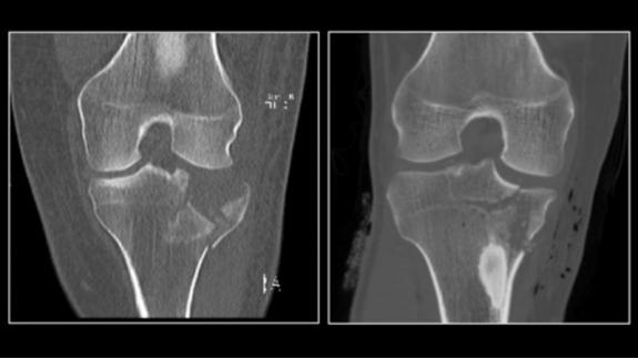 КТ скан перелому великоберцової кістки при ультра-низькій дозі (зліва)  у порівнянні зі звичайним КТ сканом