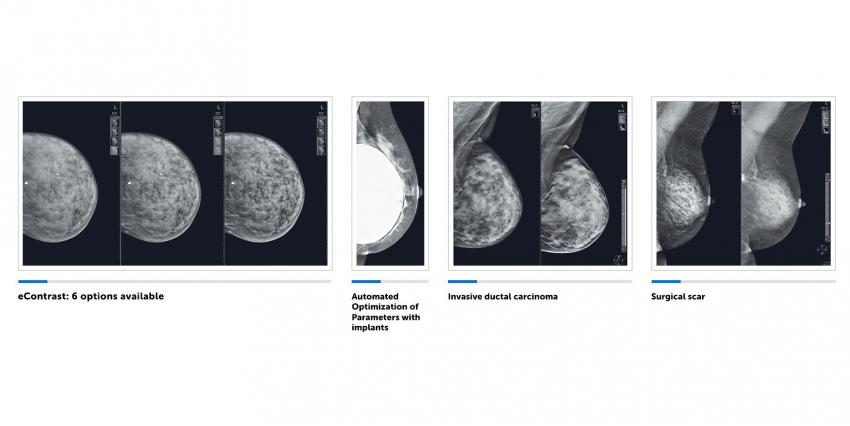Обзор системы для томосинтеза груди